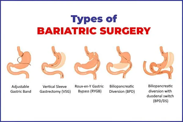 Bariatric Surgery in Indirapuram