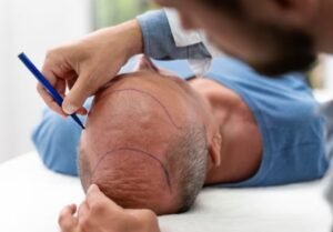 Read more about the article Who Performs the Hair Transplant Procedures at Madhup Hospital?