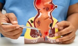 Read more about the article What are the Benefits of Choosing Minimally Invasive Procedures for the Best Piles Treatment in Indirapuram?