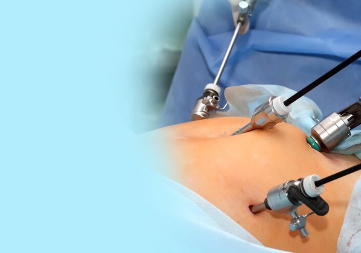 You are currently viewing Why Should I Choose a Laparoscopic Surgeon in Indirapuram for Minimally Invasive Surgery?