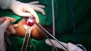 Read more about the article What Are the Different Types of Piles Surgery Available?