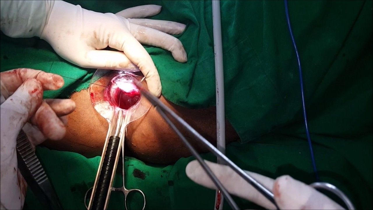 You are currently viewing What Are the Different Types of Piles Surgery Available?