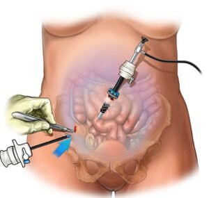 Read more about the article What Are the Benefits of Choosing Laparoscopic Surgery in Indirapuram?
