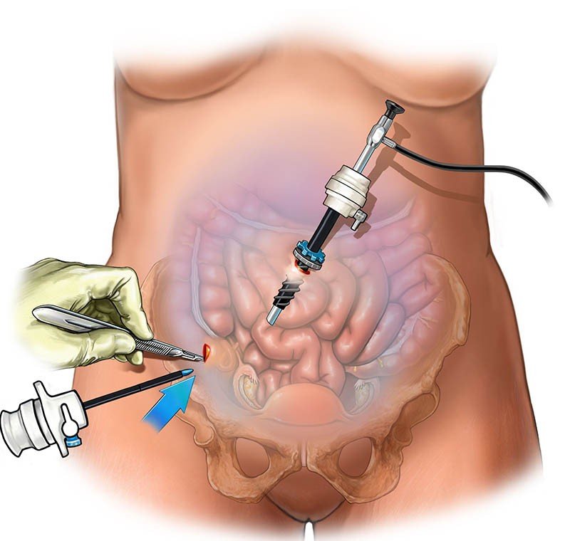 You are currently viewing What Are the Benefits of Choosing Laparoscopic Surgery in Indirapuram?